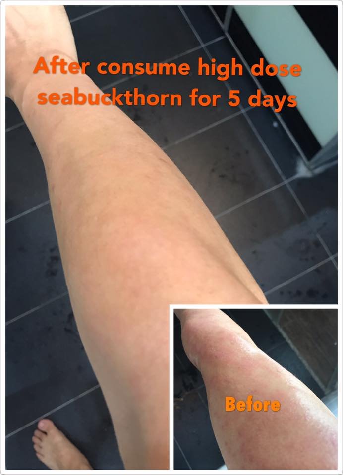 Bio+ Organic Seabuckthorn Extract - Eczema Case 1